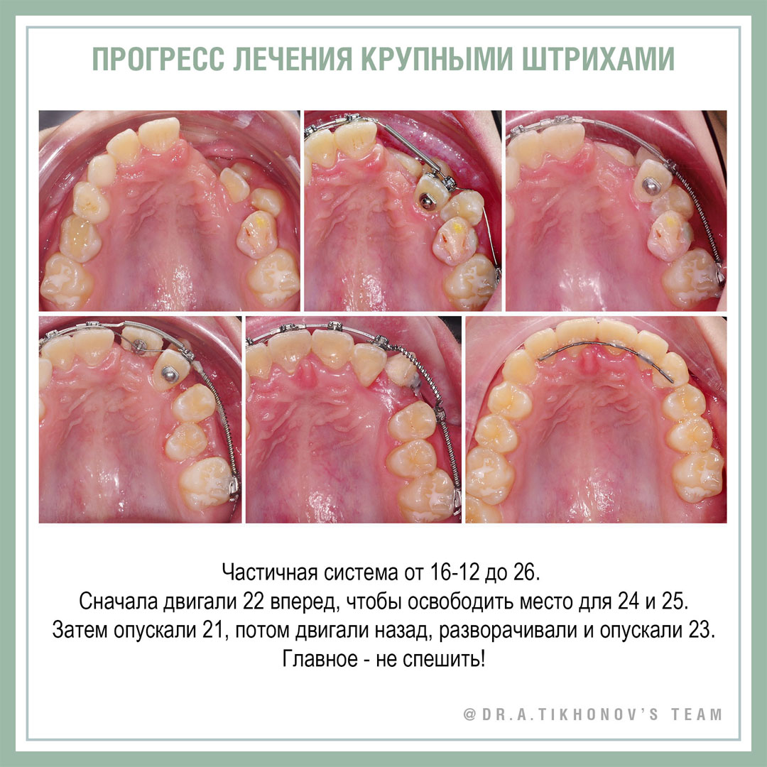 Ретенция и частичная транспозиция. 1 этап лечения. - интересно об  ортодонтии, имплантации и протезировании зубов